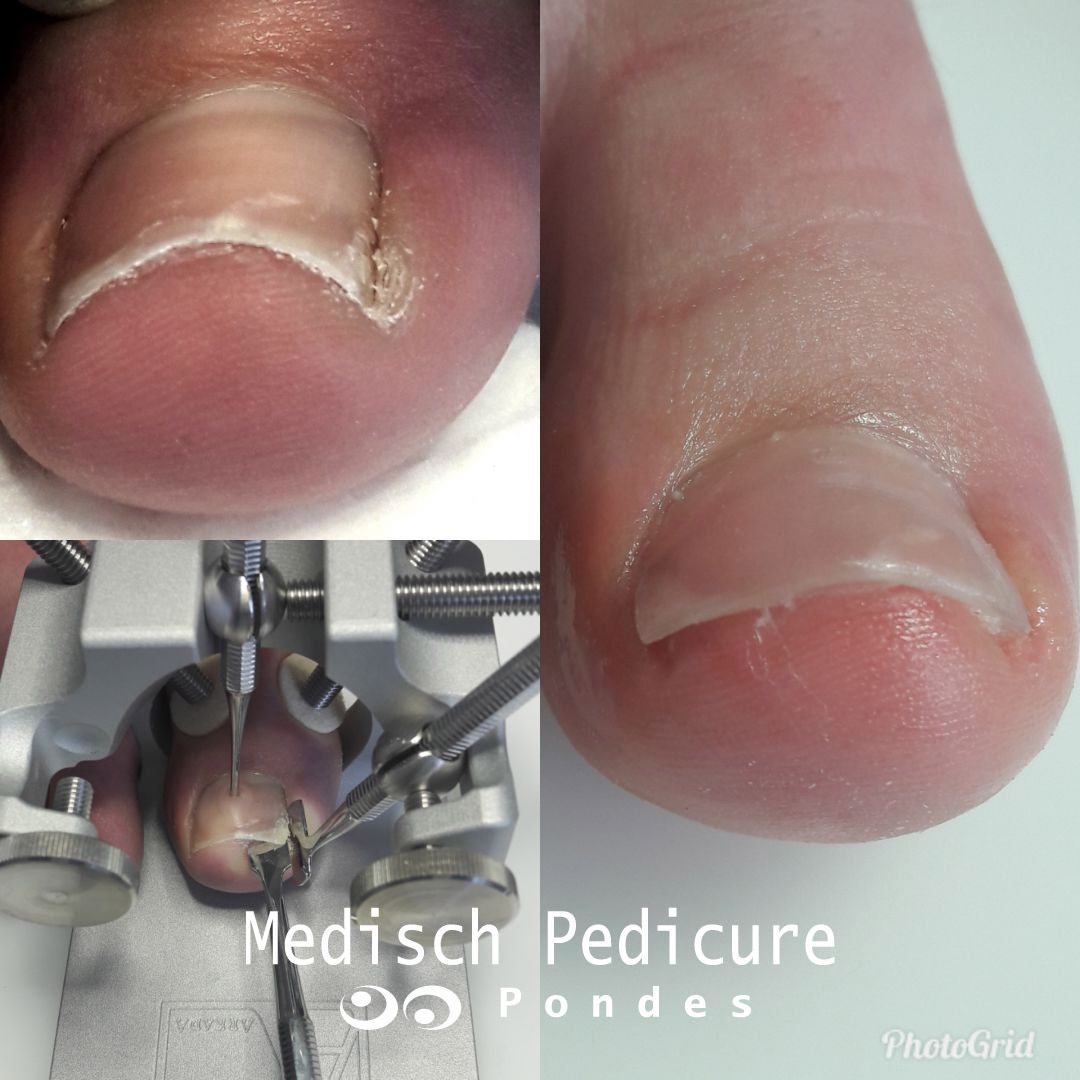 Arkada techniek - Medisch Pedicure Pondes
